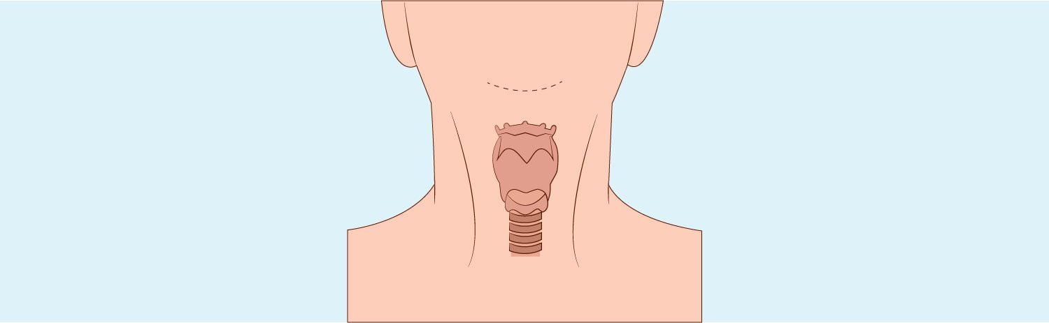 Tracheal Shave