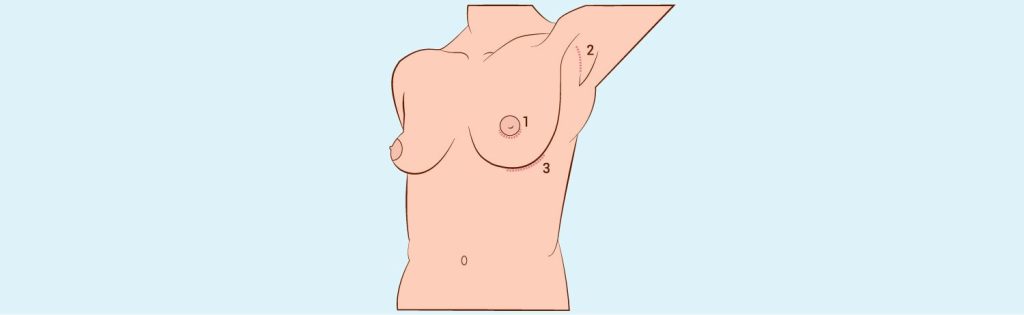 Breast Augmentation