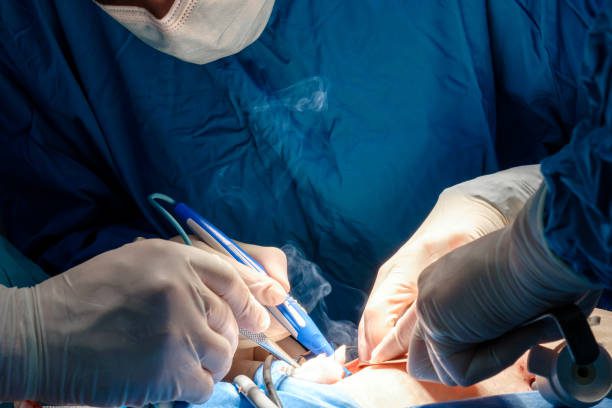 外科医生在手术过程中握住电凝器。烧焦的肉冒烟。手术图库照片、免版税照片和图片