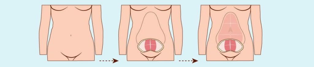 Abdominoplastie