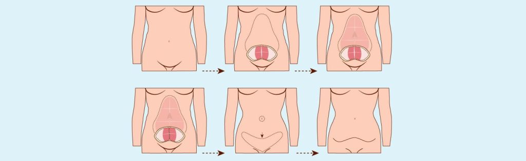 Abdominoplastie