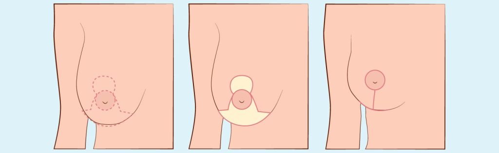 Breast Lift
