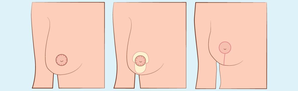 Breast Lift