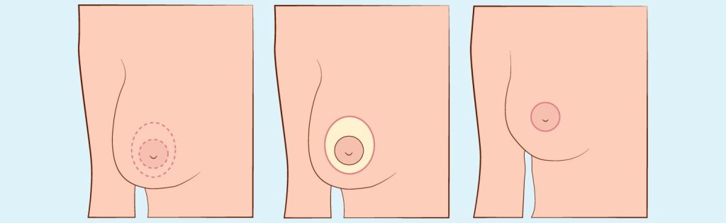 Breast Lift