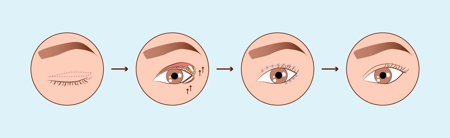 Cirurgia Palpebral