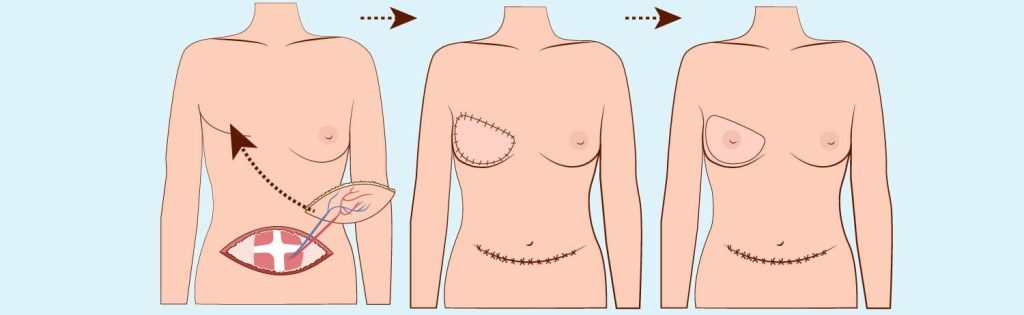 Breast Reconstruction