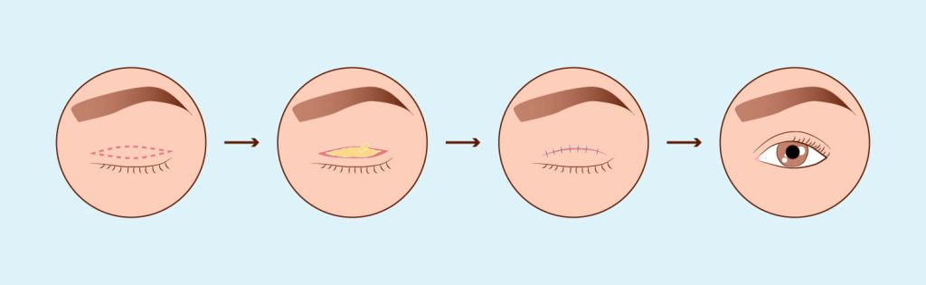 Blepharoplastik Augenlidchirurgie Augenlidstraffung VorherNachher
