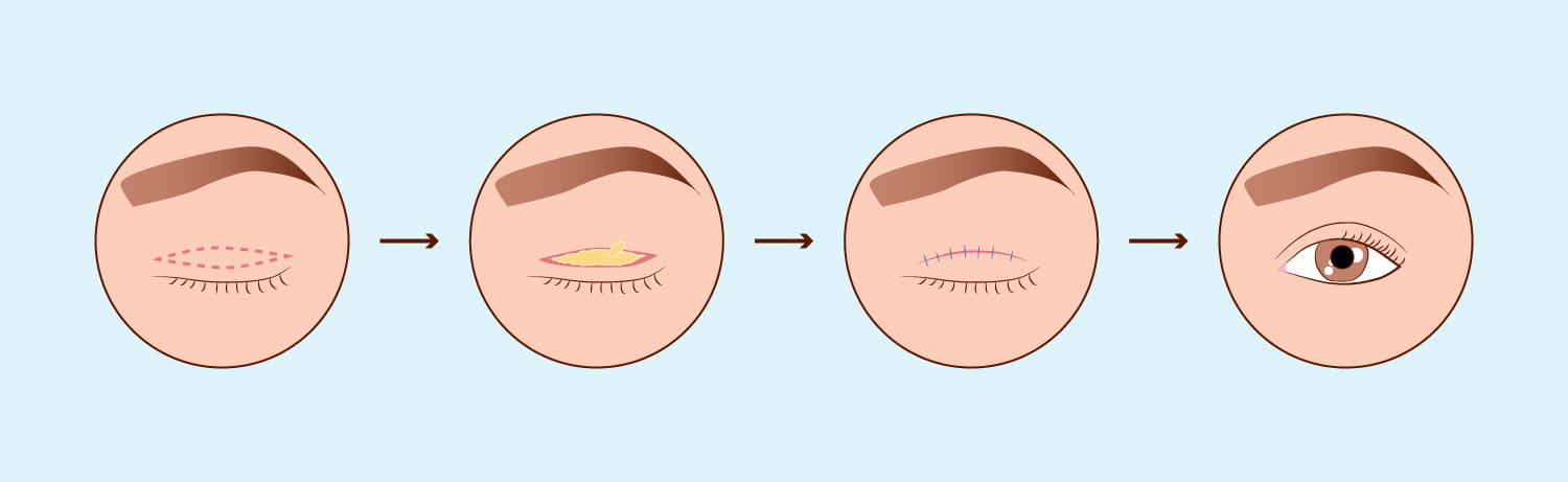 Cirurgia Palpebral