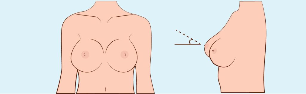 MONOBOOB - the causes and treatment of this potential complication