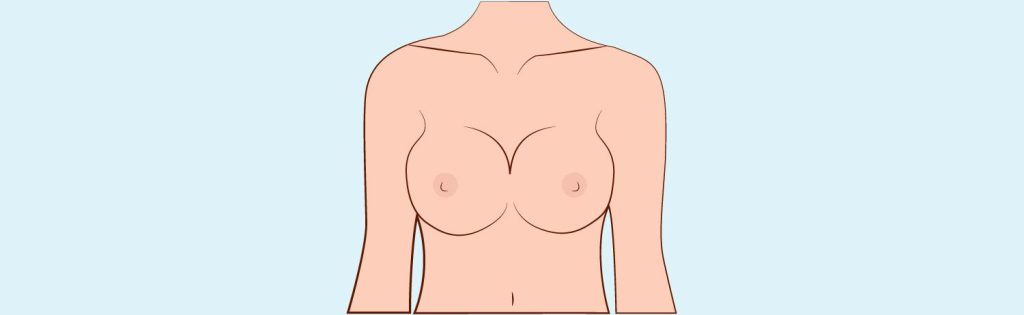 Implant mammaire