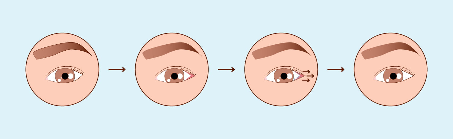 Augenlidchirurgie