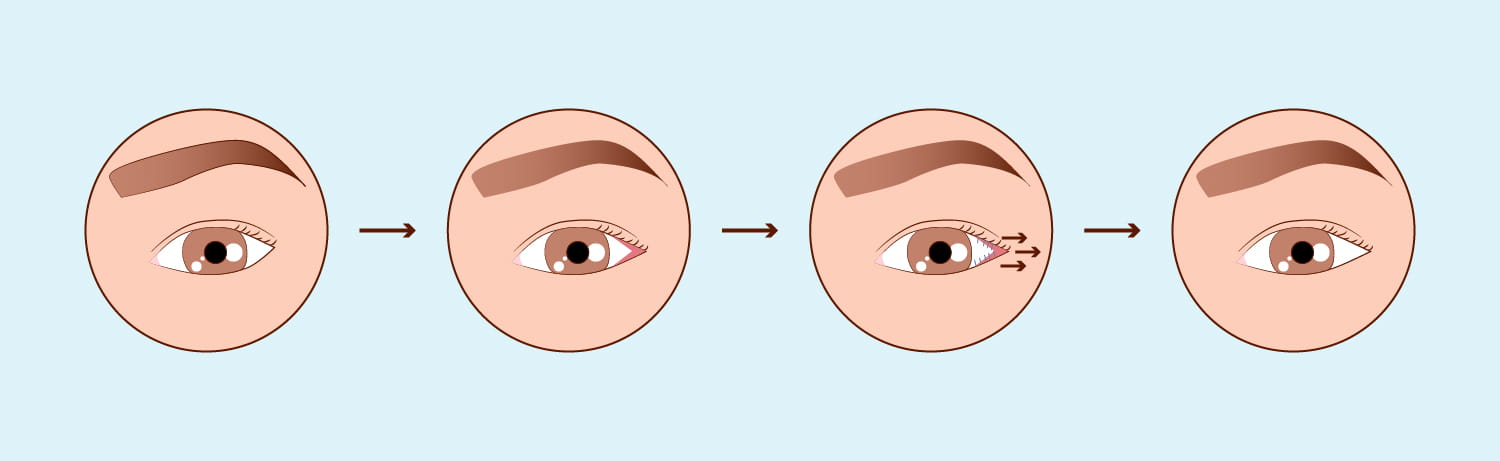 Cirurgia Palpebral