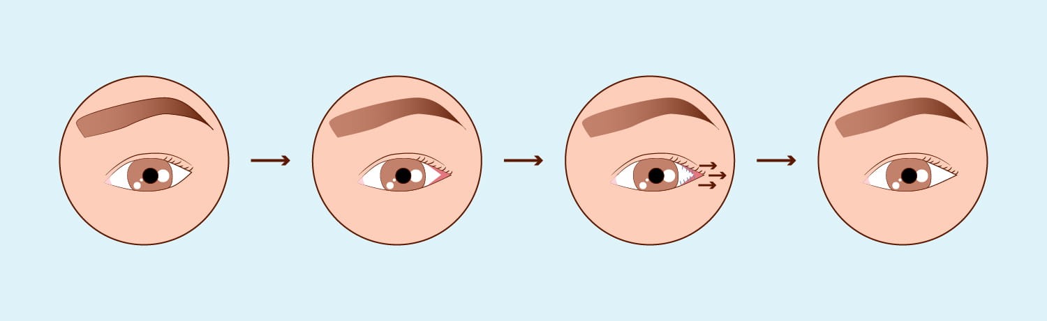 Cirurgia Palpebral