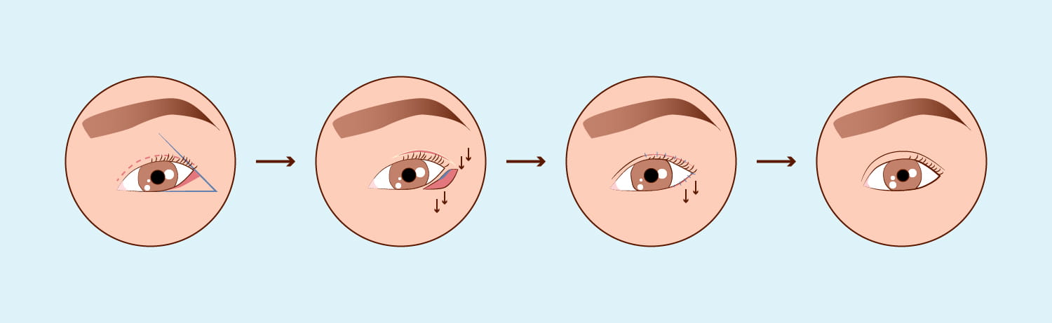 Cirurgia Palpebral