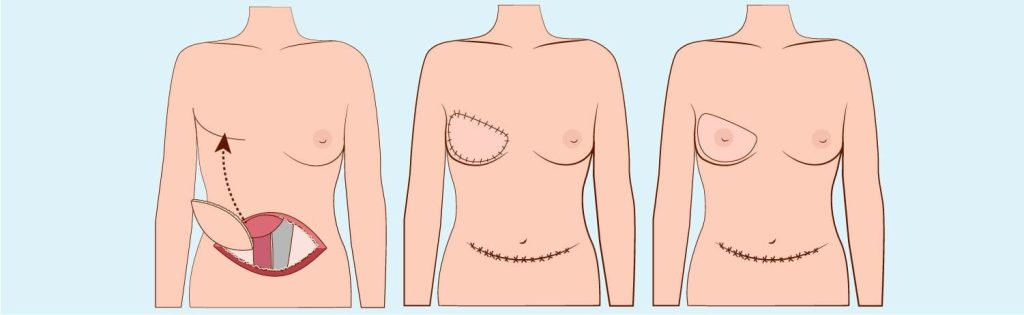 Breast Reconstruction