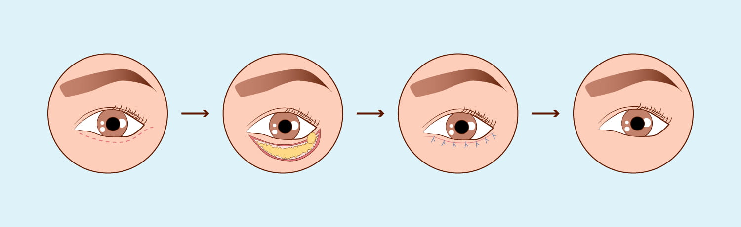 Chirurgie Des Paupières