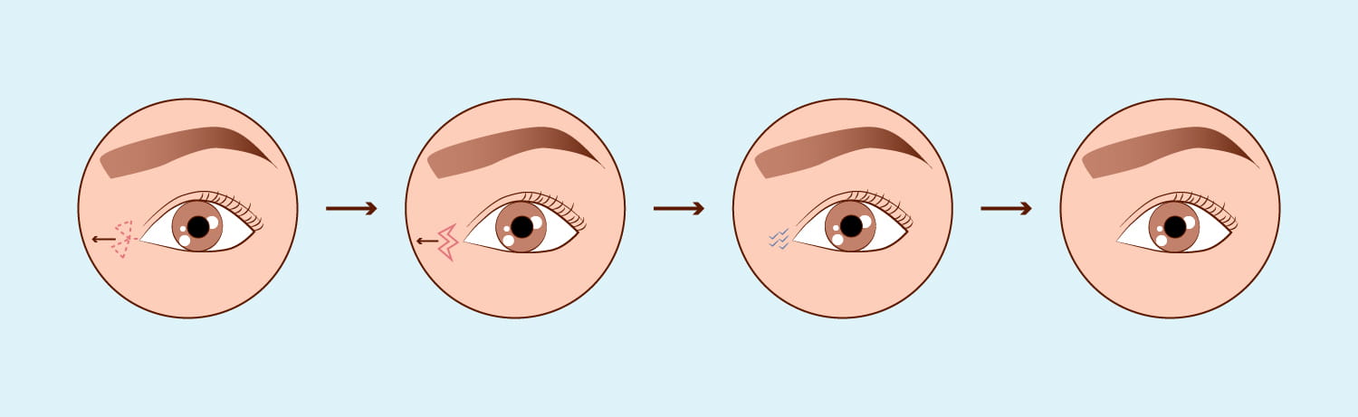 Cirurgia Palpebral