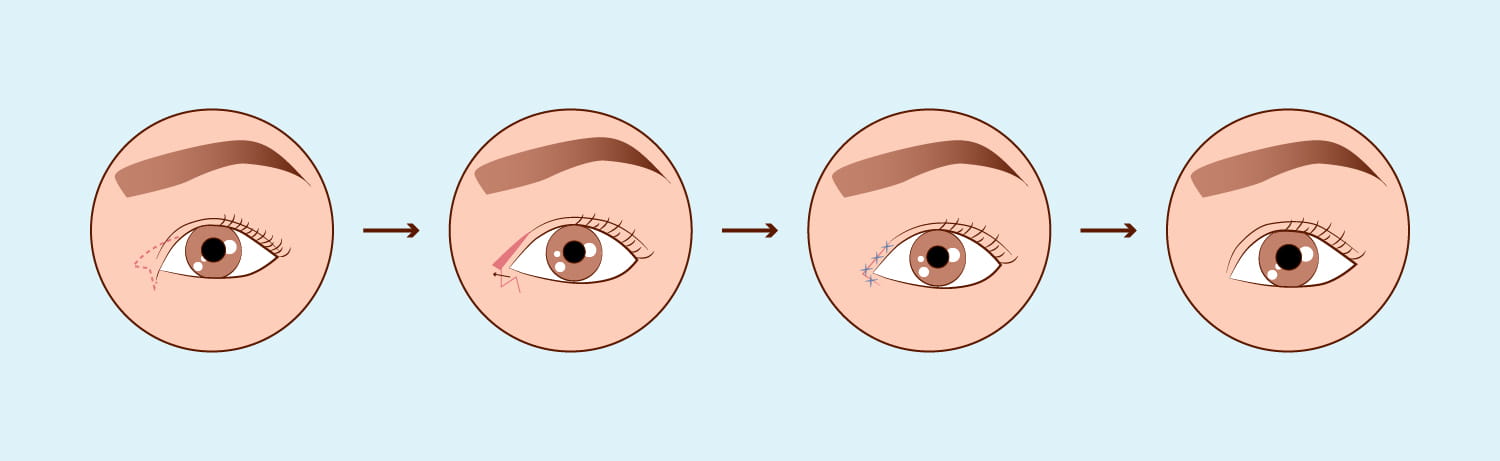 Augenlidchirurgie
