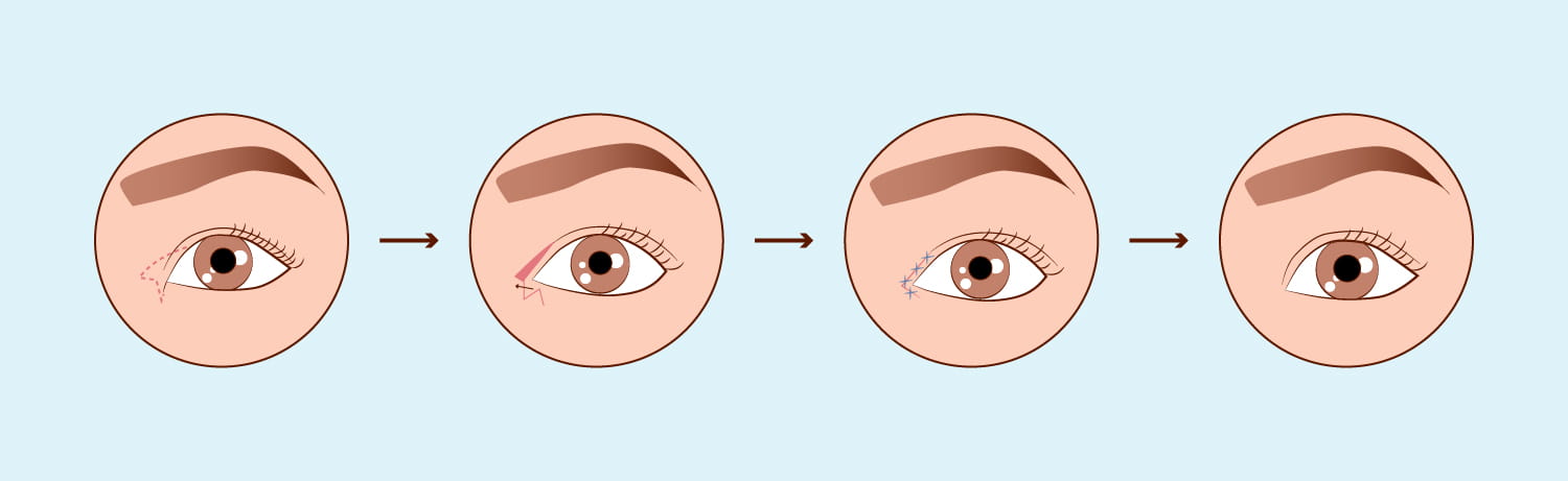 Cirurgia Palpebral